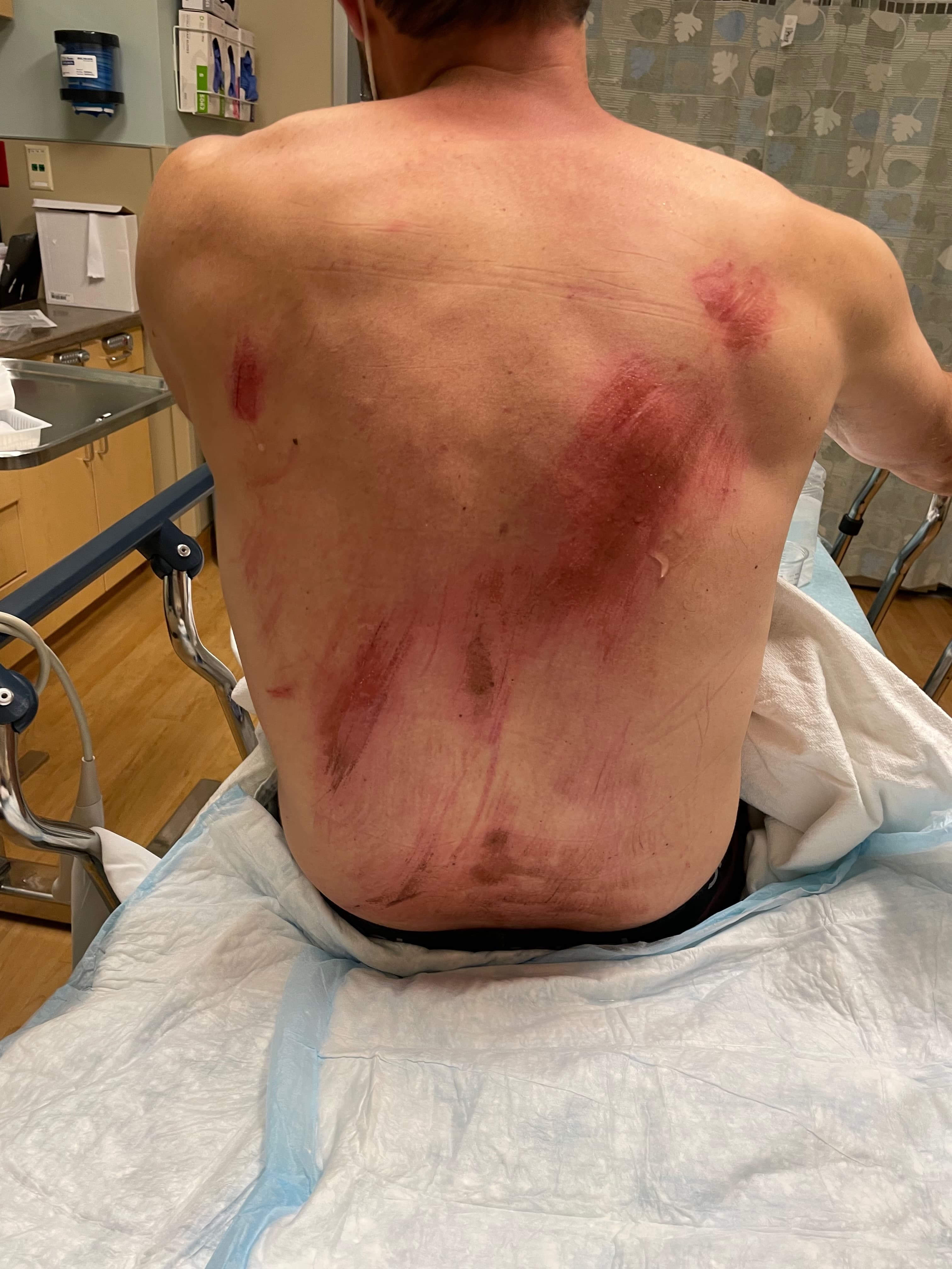 Mountain biking injury scrapes.